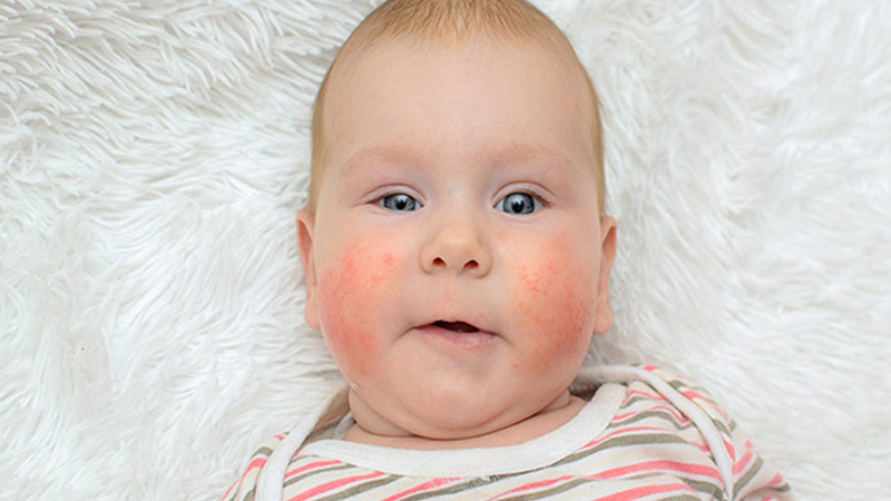 Dấu hiệu của bệnh chàm sữa ở trẻ: bị hai bên má