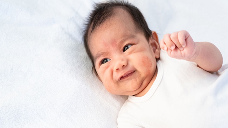 Bệnh chàm sữa dễ gây ra sẹo cho bé
