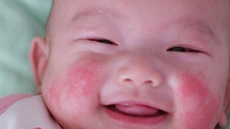 Trẻ sơ sinh bị chàm sữa trên mặt hoàn toàn có thể tự khỏi nếu cha mẹ biết cách điều trị kiểm soát tốt tại nhà