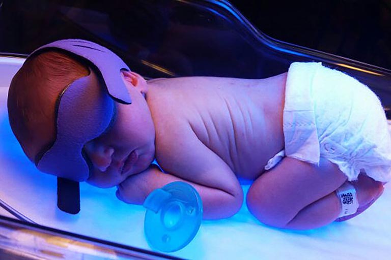 Chiếu đèn điều trị vàng da cho trẻ sơ sinh