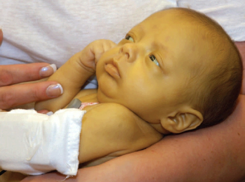Vàng da ở trẻ sơ sinh do tích tụ bilirubin trong máu