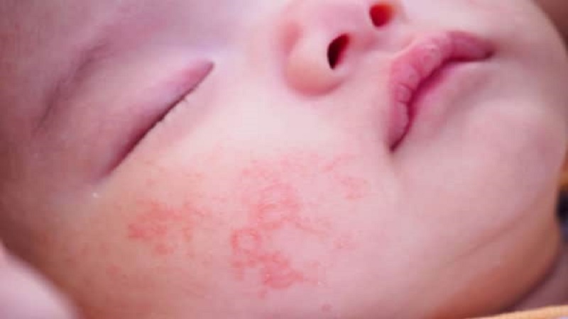 Trẻ sơ sinh bị viêm da nhẹ ở má
