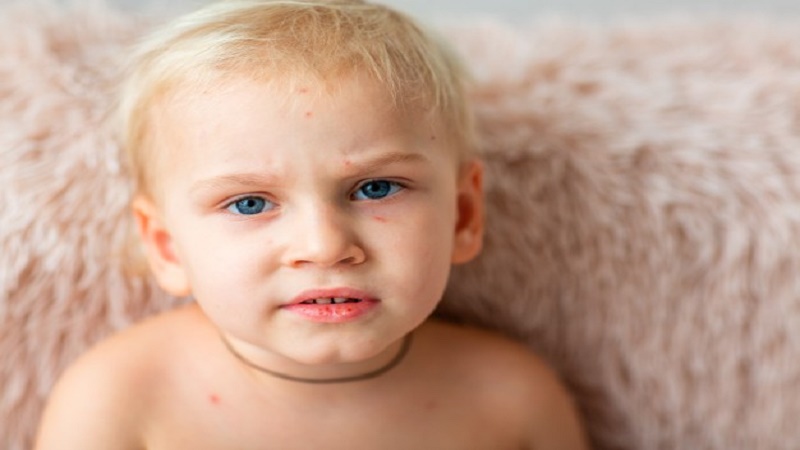 Nổi mụn đầu trắng ở trẻ em có thể là dấu hiệu của nhiều bệnh ngoài da khác nhau