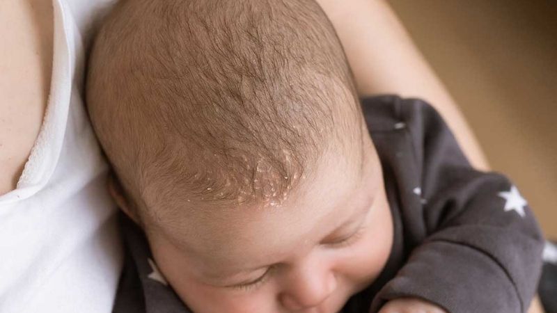 Viêm da tiết bã da đầu ở trẻ sơ sinh gây ra tình trạng đóng vảy ở trên đầ