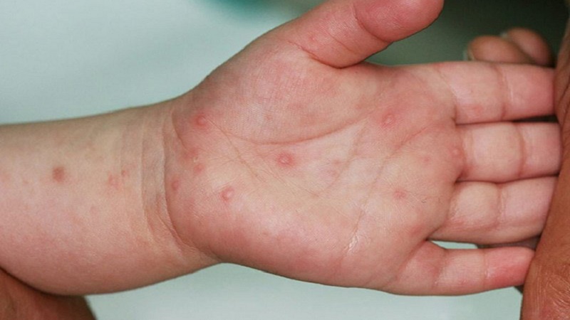 Biểu hiện điển hình của bệnh là trẻ bị sốt và nổi các bóng nước ở lòng bàn tay, bàn chân