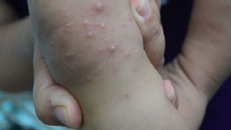 Bệnh viêm da bóng nước ở trẻ em là một nhóm gồm các bệnh lý ngoài da: Chân tay miệng, thủy đậu, nhiễm trùng da, zona