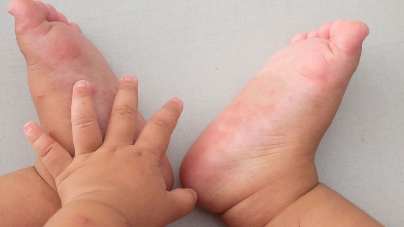 Trẻ sơ sinh bị dị ứng mẩn ngứa có thể là do thời tiết hoặc do mắc bệnh ngoài da