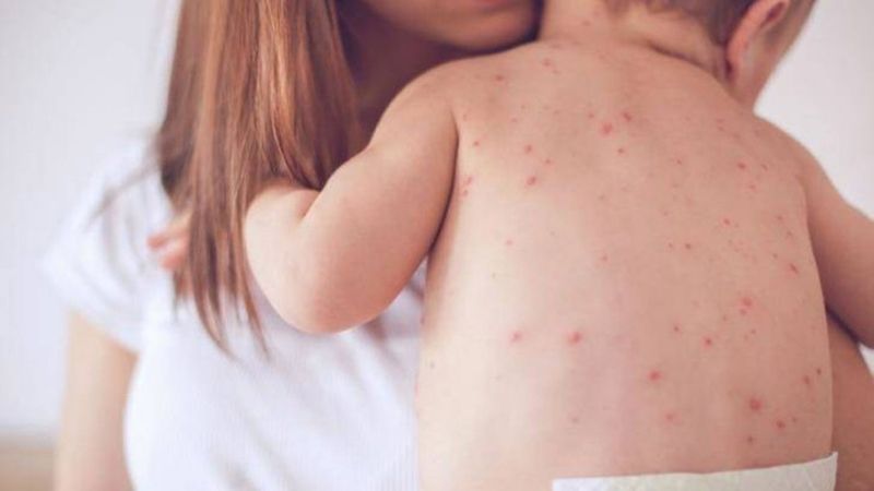 Trẻ sẽ bị nổi ban ở lưng khi bị sốt phát ban