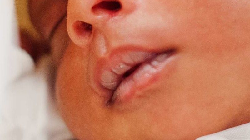 Trẻ sơ sinh bị tróc da môi có bình thường không?