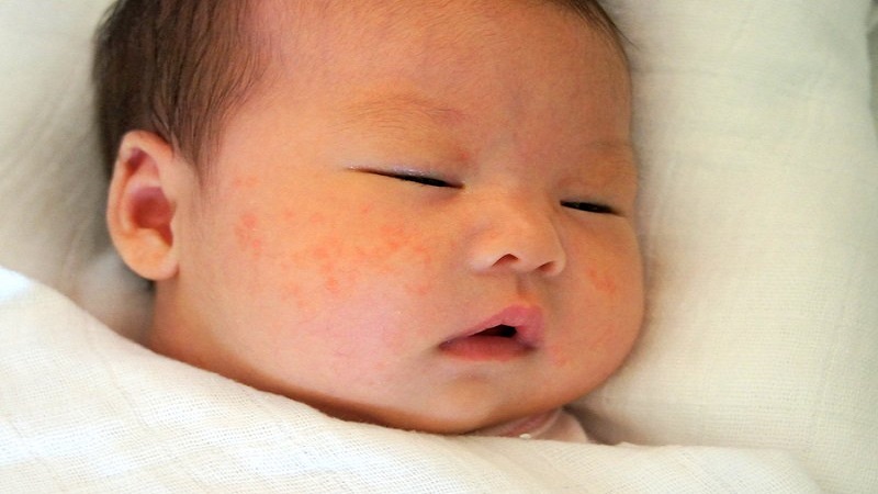 Trẻ sinh non thường cό khả nӑꞑg mắc bệnh sởi cao hơn so với trẻ sinh ᵭủ tháng