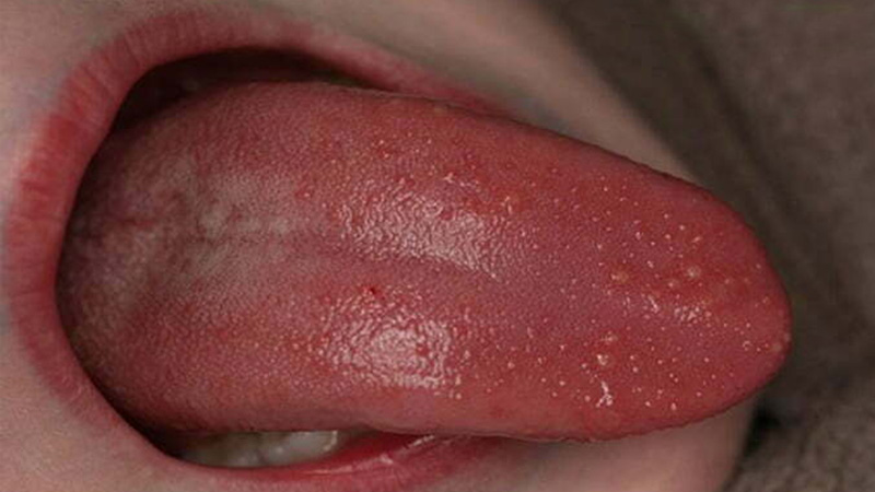 Nấm lưỡi có kèm chảy máu ở trẻ khiến trẻ đau rát, khó chịu