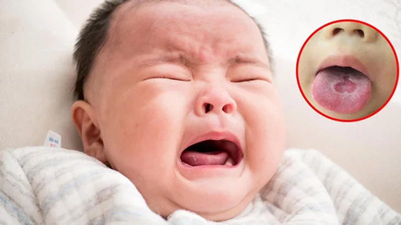 Nấm lưỡi ở trẻ sơ sinh có nguy hiểm không?