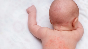 Trị rôm sảy bằng thảo dược cho trẻ sơ sinh: An toàn, dịu nhẹ