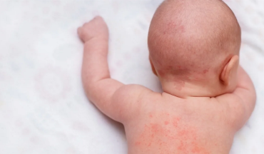 Trị rôm sảy bằng thảo dược cho trẻ sơ sinh: An toàn, dịu nhẹ