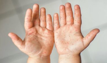 Bé bị mẩn đỏ khắp người là dấu hiệu gì? Nguyên nhân và cách xử lý mẹ cần biết