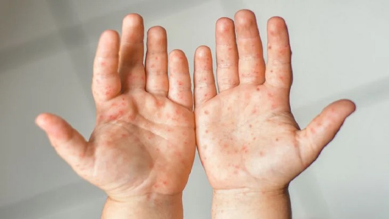 Bé bị mẩn đỏ khắp người là dấu hiệu gì? Nguyên nhân và cách xử lý mẹ cần biết