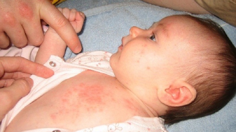 Chăm sóc da bé khi bị rôm sảy: nhanh khỏi, không để lại thâm sẹo