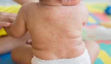 Phòng ngừa rôm sảy cho trẻ vào mùa nóng