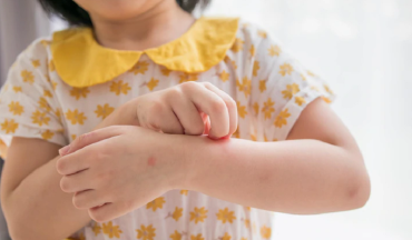 Bé bị nổi mẩn đỏ do thời tiết: Nguyên nhân và cách xử lý an toàn cho mẹ bỉm