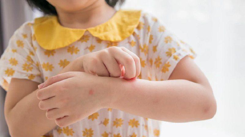 Bé bị nổi mẩn đỏ do thời tiết: Nguyên nhân và cách xử lý an toàn cho mẹ bỉm