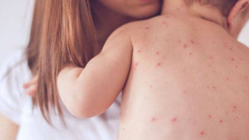 Nhận biết mẩn đỏ nguy hiểm ở trẻ sơ sinh và thời điểm mẹ cần đưa bé đi khám