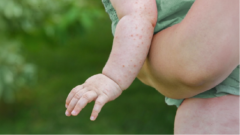 Sai lầm khi trị rôm sảy cho bé – 90% cha mẹ mắc phải