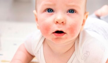 Trẻ bị chàm sữa tái phát liên tục: Có phải do sữa, thời tiết hay cách chăm sóc da sai cách?