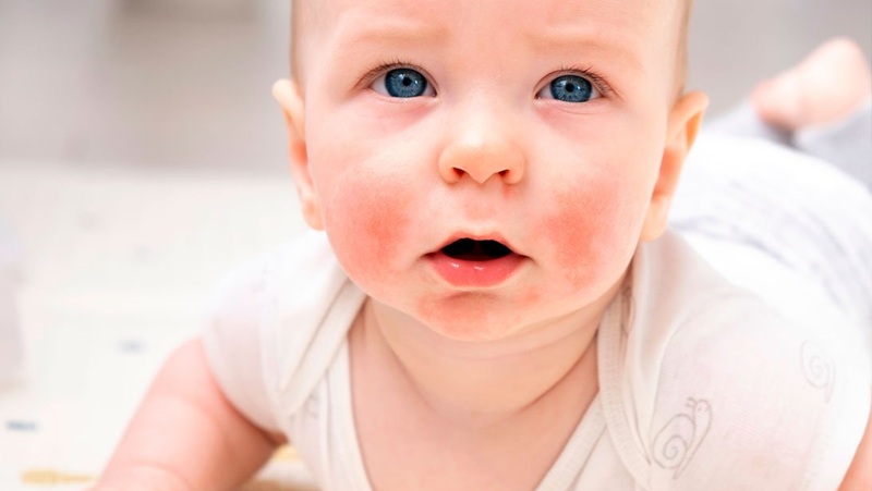 Trẻ bị chàm sữa tái phát liên tục: Có phải do sữa, thời tiết hay cách chăm sóc da sai cách?