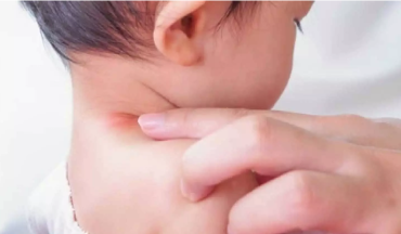 Trẻ sơ sinh bị viêm da quanh cổ, nách: Vì sao vùng nếp gấp dễ bị nặng hơn?