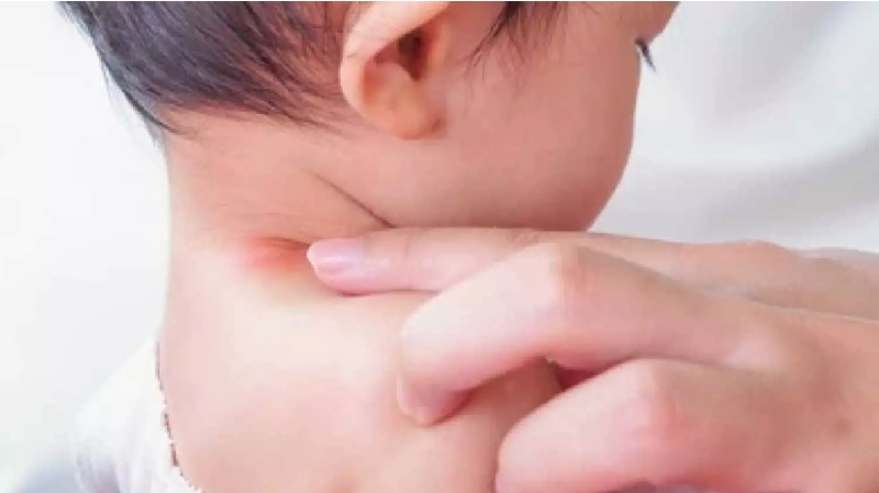 Trẻ sơ sinh bị viêm da quanh cổ, nách: Vì sao vùng nếp gấp dễ bị nặng hơn?