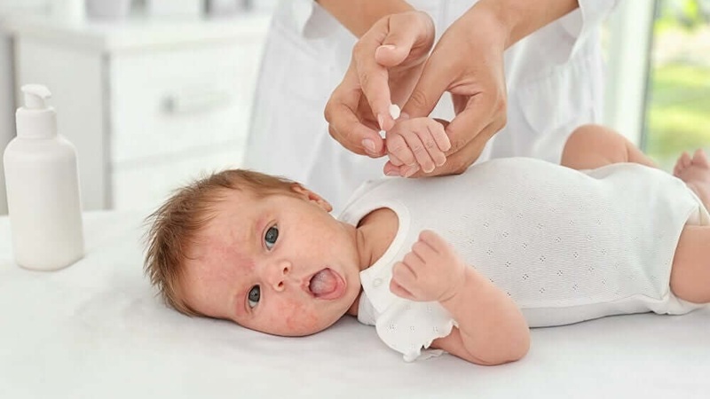 Cách phục hồi da cho bé bị viêm da an toàn, hạn chế khô rát và tái kích ứng