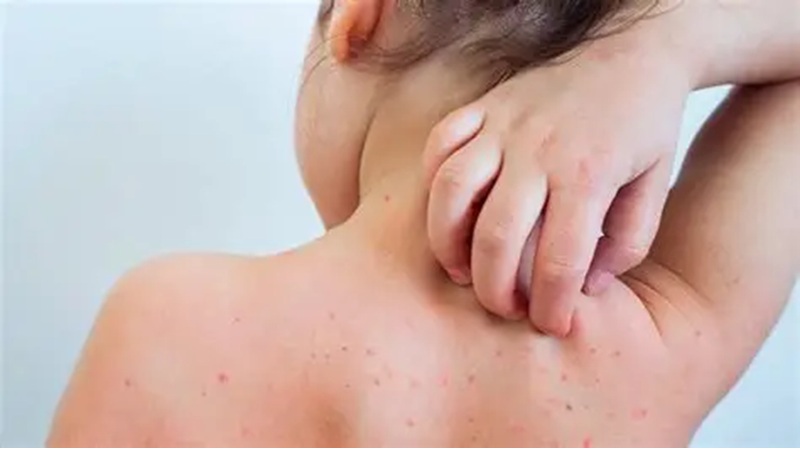 Da trẻ nổi mụn nhọt
