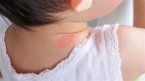 Mẩn đỏ ở vùng cổ