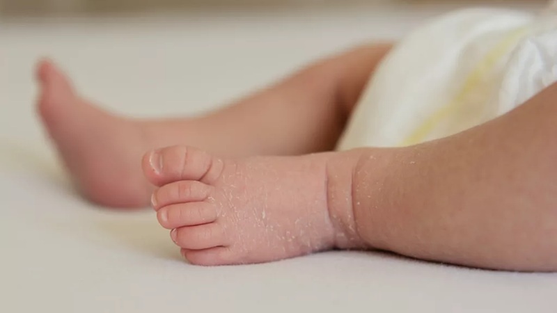 Tình trạng khô da ở trẻ nhỏ